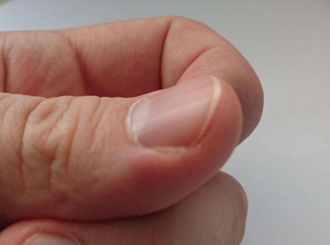 Can You Get Calluses from Playing Piano