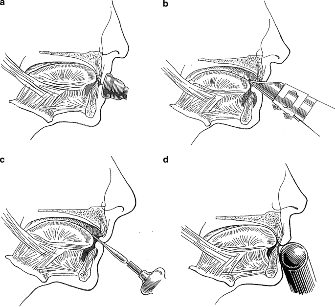 Does Playing Saxophone Change Your Face