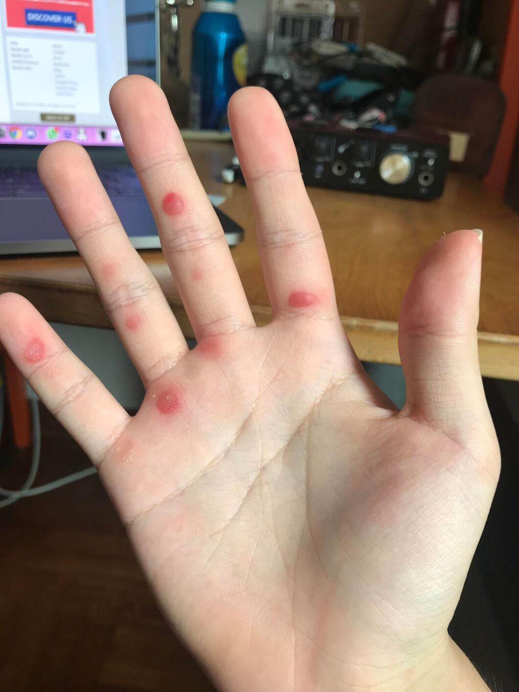 Can Your Hands Bleed from Drumming